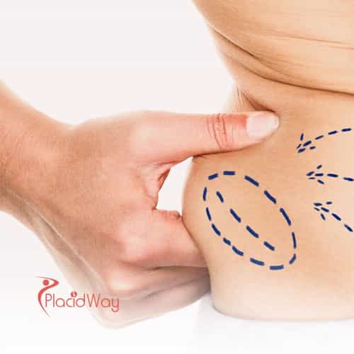 Why Mexicali, Mexico is the Top Choice for Affordable Liposuction for Arizona Residents